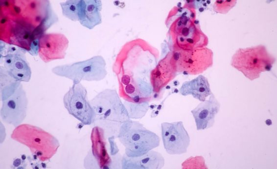 At first this may look similar, but look at the different colors and sizes of the nuclei in the cells. They are especially different in the bluer cells that are deeper in the cervical lining, This indicates abnormal growth and could not be easily detected without stains.