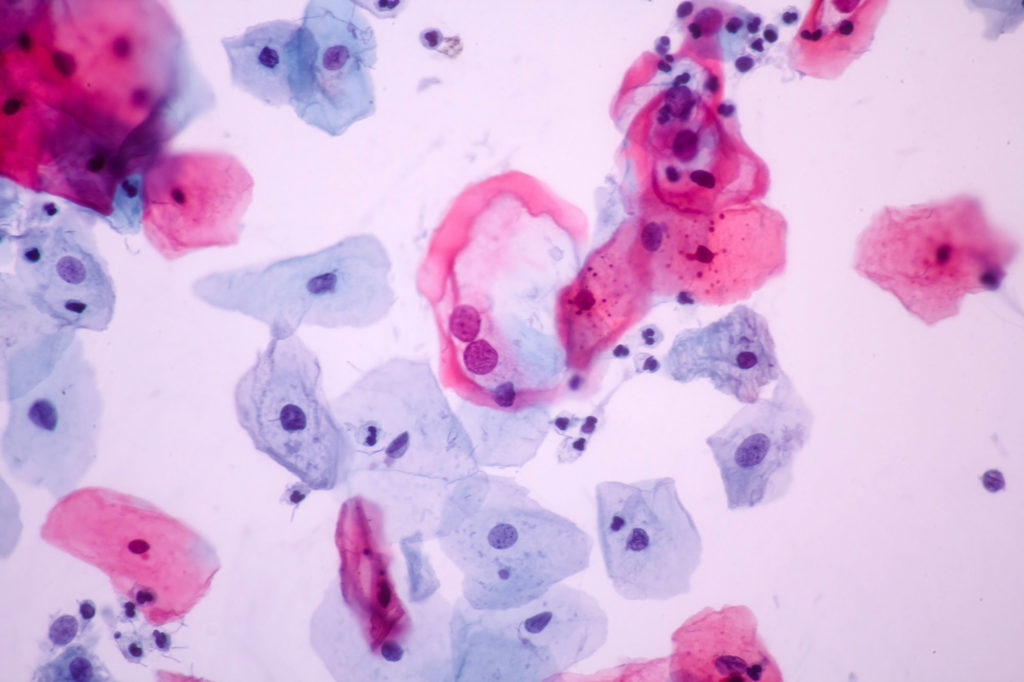 At first this may look similar, but look at the different colors and sizes of the nuclei (small circles) within the cells.  They are especially different in the bluer cells that are from deeper in the cervical lining. 
 This indicates abnormal growth and could not be easily detected without stains.