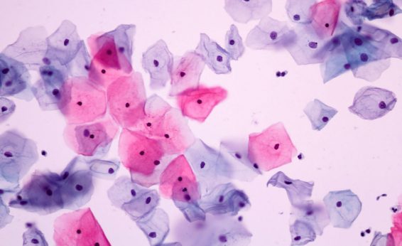 The normally colorless cells are staining shades of pink and purple, which indicates different stages of the cells. The pink were on the surface being sloughed off, the purple were a bit deeper in the lining tissue. The are all about the same size with similar size and shape nuclei (dark purple dots).