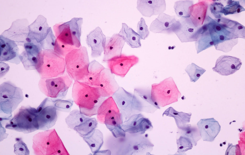 The normally colorless cells are staining shades of pink and purple, which indicates different stages of the cells.  The pink were on the surface being sloughed off, the purple were a bit deeper in the lining tissue.  The are all about the same size with similar size and shape nuclei (dark purple dots).